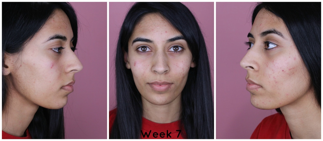 Week 7 of using Tria Blue Light Therapy