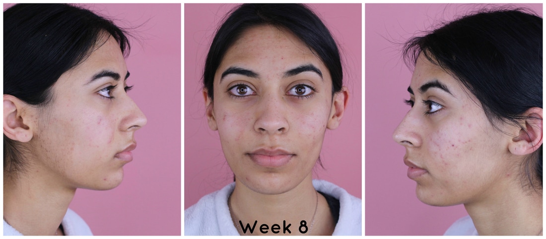 Week 8 of using Tria Blue Light Therapy